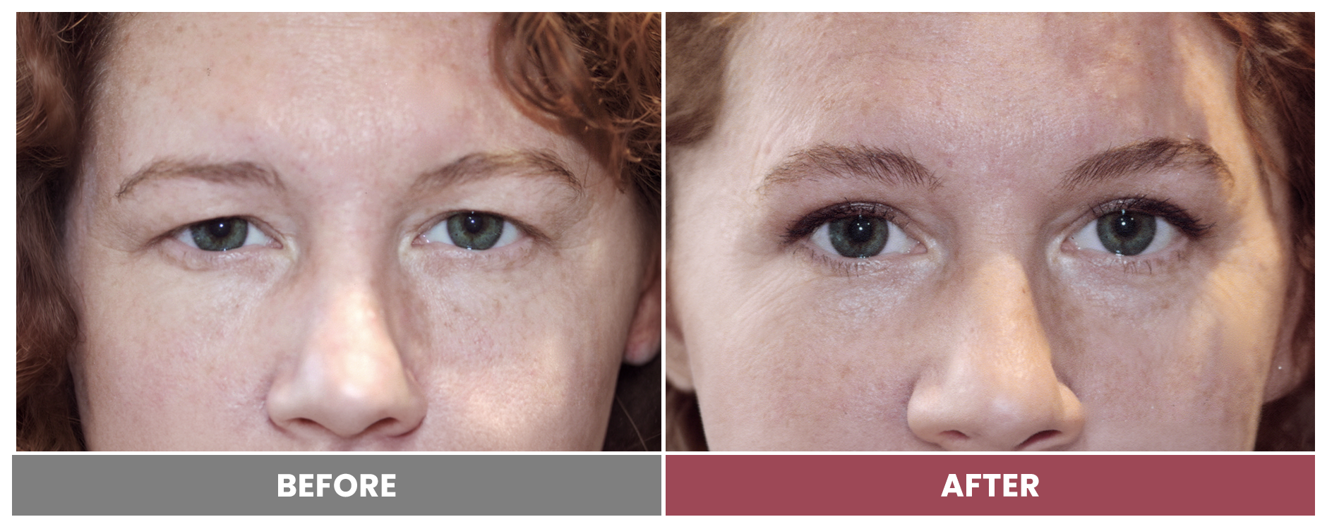Upper Blepharoplasty - Case 54